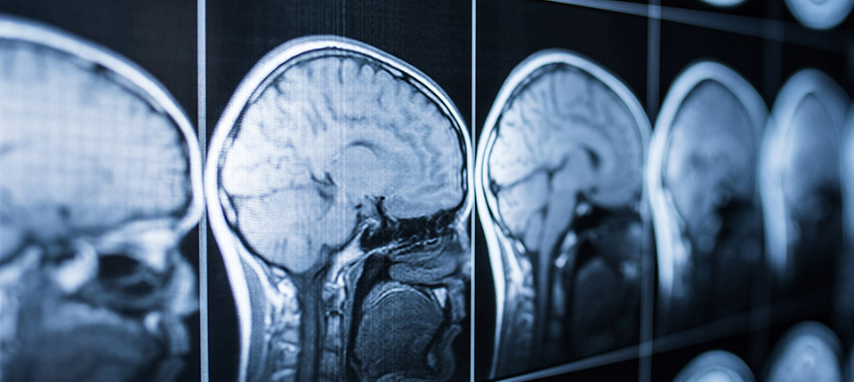 3 High-Risk Groups for Traumatic Brain Injury