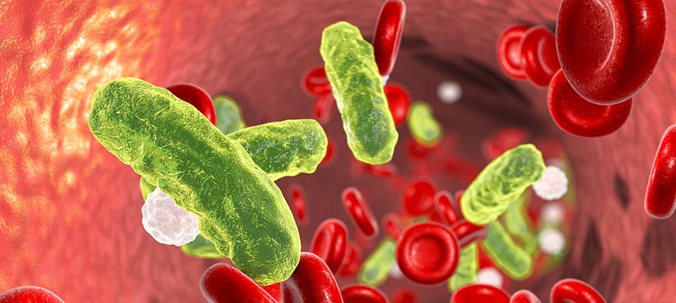 Decoding the Mysterious Sepsis